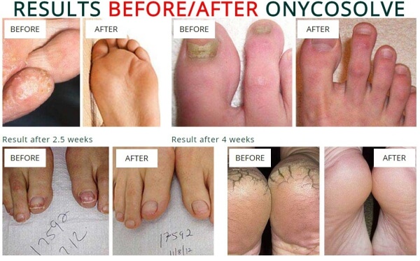 Onycosolve spray, effects, results, fungal infections