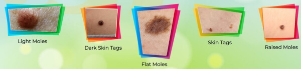 Moles, Skin Tags and Warts