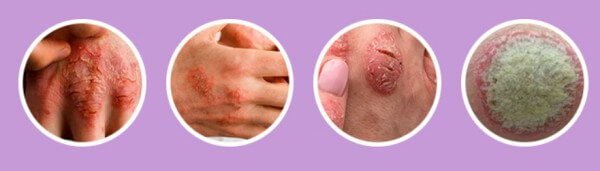 Psoriasis, Skin Disorder