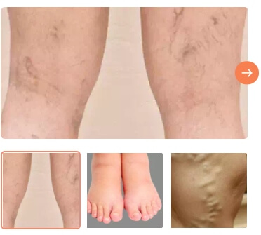 varicose veins cooling gel